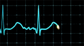 What is Heart Palpitations?